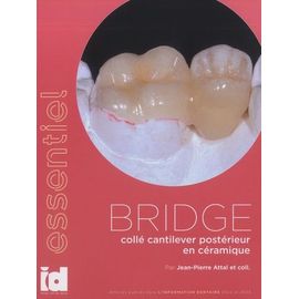 Bridge Collé Cantilever Postérieur En Céramique