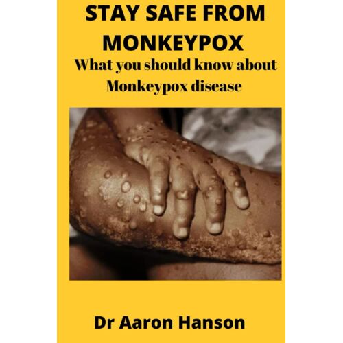 Stay Safe From Monkeypox : What You Should Know About Monkeypox Disease