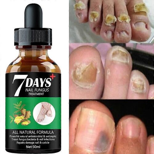 7days Nail Fungus Traitement Essence Sérum Soin Soins Mains Et Pieds Enlèvement Gel Réparateur Anti-Infectieux 
