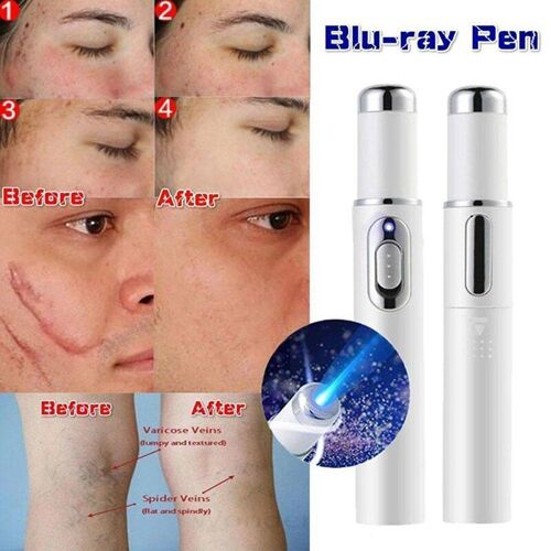 Stylo Laser Pour Varices, 1 Pièce, Thérapie À La Lumière Bleue, Pour Les Rides, L'acné, Les Varices
