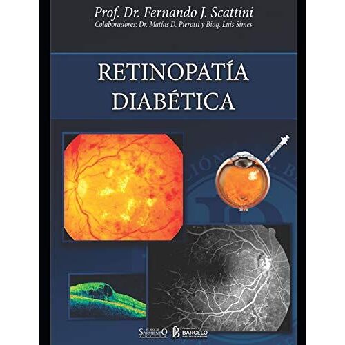 Retinopatía Diabética: Oftalmología