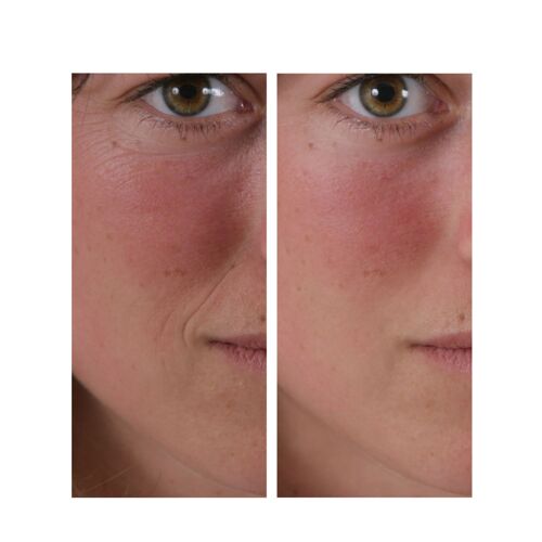 Skineance - Combleur De Rides Wrinkle Filler  Lisse, Comble Et Estompe Les Rides Et Ridules - Résultats Précis, Instantanés Et Durables  Efficacité Prouvée - Lot De 3 Tubes De 15 Ml 