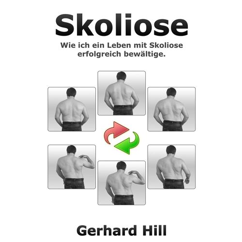 Skoliose