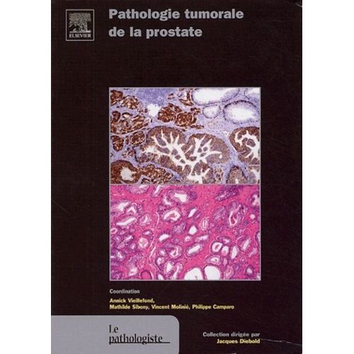 Pathologie Tumorale De La Prostate