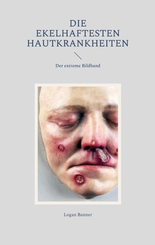 Die Ekelhaftesten Hautkrankheiten