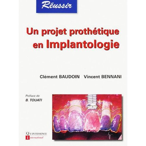 Un Projet Prothètique En Implantologie