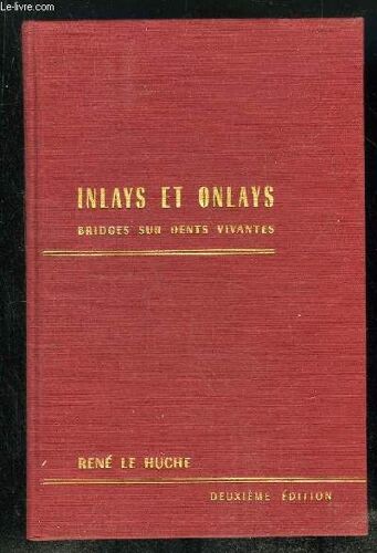 Inlays Et Onlays Bridges Sur Dents Vivantes. 2em Edition.