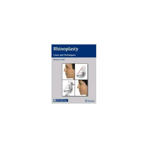 Rhinoplasty