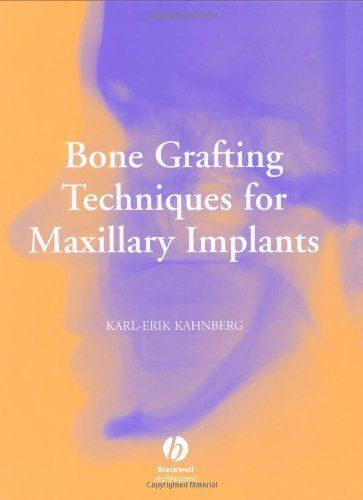 Bone Grafting Techniques For Maxillary Implants
