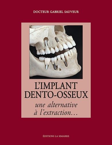 L'implant Dento-Osseux - Une Alternative À L'extraction