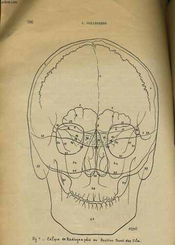 Notes Pratiques Sur L'exploration Radiologique Des Traumatismes Craniens - N°5