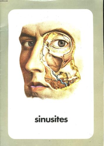 Sinusites