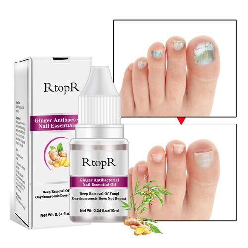 Xeme Traitement Antibactérien Des Ongles Au Gingembre Onychomycose Paronychia Anti-Fongique Infection Des Ongles Orteil Des Ongles Champignon
