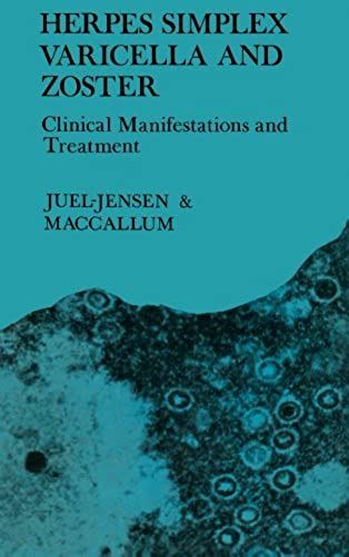 Herpes Simplex Varicella And Zoster: Clinical Manifestations And Treatment
