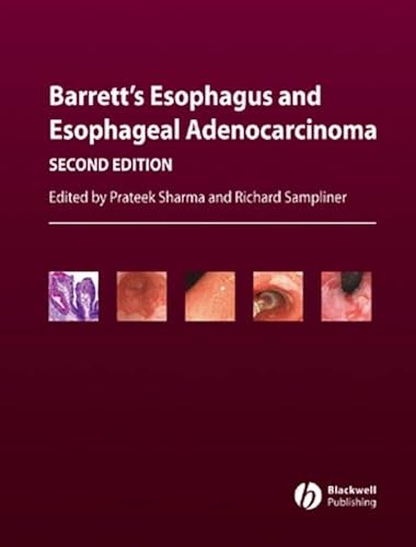 Barrett's Esophagus And Esophageal Adenocarcinoma